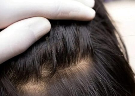 سن شایع آلودگی کودکان با شپش سر ۳ تا ۱۲ سال است