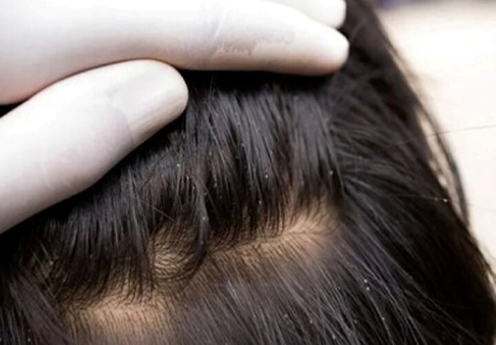 سن شایع آلودگی کودکان با شپش سر ۳ تا ۱۲ سال است